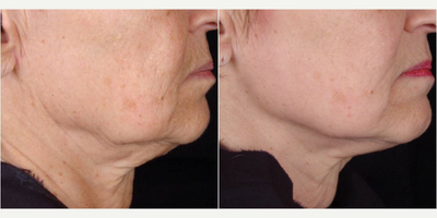 55-64 year old woman treated with TITAN - Skin Tightening of jowls, lower face  and lateral neck with TITAN