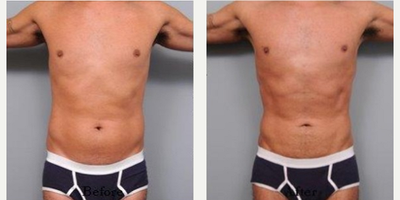 Patient treated with Smart Lipo - Patient treated with Smart Lipo