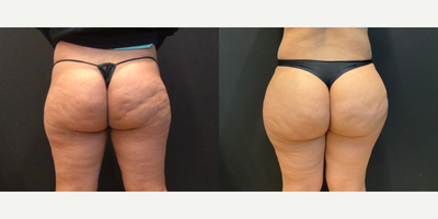 Woman treated with Aveli - Woman treated with Aveli