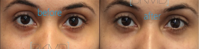 Restylane under eye fillers for tear trough hollows - This woman underwent cannula Restylane fillers for her tear troughs to reduce the dark circles and shadows