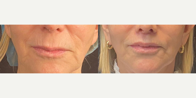 Woman treated with Lip Lift - Lip Lift 20mm to 13mmSubtlety with the ability to make a real change is the key to plastic surgery. If you look closely I performed a lip lift taking her lip length from 20mm to 13mm. The numbers aren't so important the crucial thing is to make the scar as invisible as possible and end result harmonious with her face.