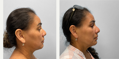 35-44 year old woman treated with Eyelid Surgery - This woman in her mid-forties came to discuss her options for facial rejuvenation with Dr. Tucker. Her concerns centered around droopy upper eyelids and undereye bags. She had excess lid skin with minimal fat making her a good candidate for an upper and lower lid blepharoplasty with ptosis repair. Shown before and five months after, she looks great and has been pleased with her results.