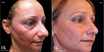 Woman treated with TotalFX - Woman treated with TotalFX
