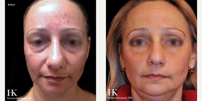 Woman treated with TotalFX - Woman treated with TotalFX