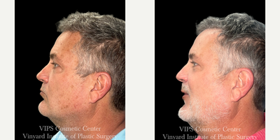 45-54 year old man treated with Skin Lightening, Skin Rejuvenation, IPL - 45-54 year old male treated with a single Elluminate Advanced Photofacial with IPL for skin concerns of age spots, sun damage and hyperpigmentation of the face. The result was an overall brightening of her skin and complexion and significantly improved age spots and sun spots giving his skin a brighter, more youthful appearance. These results were achieved with a single treatment.