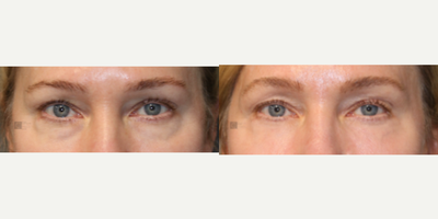 Enigmalift Scarless Lower Eyebag Removal and Laser - Enigmalift Scarless lower Eyebag Removal and Laser Resurfacing with Minimally Invasive Approach.
