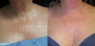 45-54 year old woman treated with Fractional Laser - Fractional radiofrequency (Sublative or eMatrix) are great options for those wanting low downtime improvements in wrinkles/crepe skin, texture/tone, scarring, pigmentation and pores.