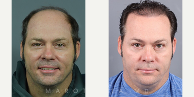 Man treated with Hair Loss Treatment - Transplant Transformation.