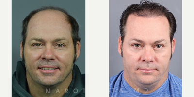 Man treated with Hair Transplant - Transplant Transformation.