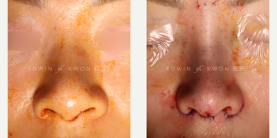35-44 year old woman treated with Asian Rhinoplasty, DCF Rhinoplasty and Alar Base Reduction - 35-44 year old woman treated with DCF Rhinoplasty. Patient has concerns about the appearance of her nose complaints of flat nasal bridge and bulbous nasal tip. Patient also felt that her nasal tip appeared too wide with flaring. The nasal bridge was not straight in her case. A unilateral left spreader graft was placed to straighten the appearance of her nose. A DCF graft was placed on top to provide more nasal bridge projection and definition. Nasal tip was refined with a combination of soft tissue debulking, bilateral cephalic trim, and increased tip projection with septal extension grafts. Patient also had a plunging tip and this was addressed with slight tip rotation. Nasal cap grafts with ear cartilage were also fashioned in place at the tip. She also underwent bilateral alar base reduction to address her flaring and wide nostrils.