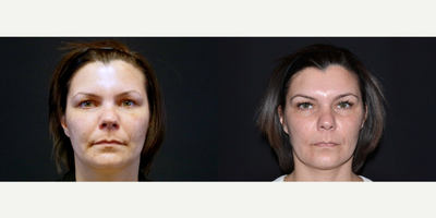 25-34 year old woman treated with IPL - 34 year old female received Cynosure IPL treatment to the face for hyper-pigmentation; photos depict the patient's results 1 month post-second treatment.