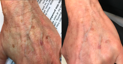 55-64 year old woman treated with IPL - IPL treatment of hands after one treatment. 3-5 treatments are recommended for best results.