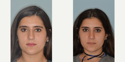 18-24 year old woman treated with Rhinoplasty - Before and after primary rhinoplasty for a patient who desired to reduce the length of her profile and refine her tip. She desired to reduce her hump and the droopy appearance of her tip on the profile view. Primary rhinoplasty techniques included hump reduction, bilateral osteotomies, bilateral spreader grafts, septal extension graft, and alar rim grafts. The columella was lengthened to improve the tip angle and the relationship between the alae and the columella. Prior to surgery she had what is referred to as a hidden columella where the nostrils hang below the level of the columella on the profile view. By lengthening the columella, the relation of the columella and the nostrils is improved which also addresses her concern of a droopy tip.