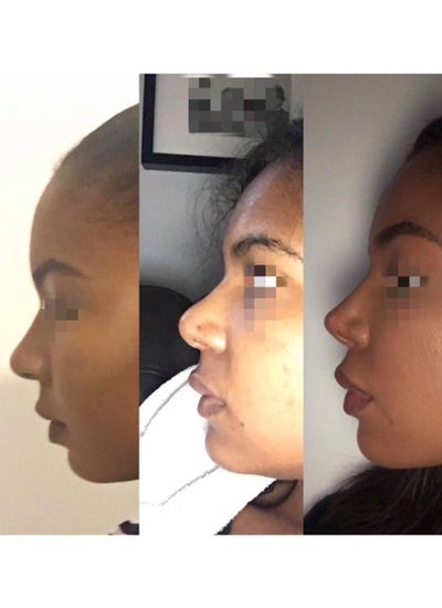 Revision Rhinoplasty With Dr Murat Enoz Istanbul Turkey