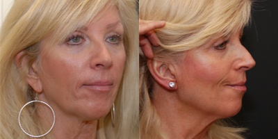 Woman treated with Ear Lobe Surgery - Ear Lobe Surgery