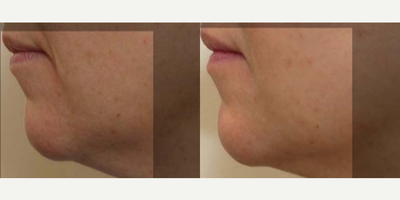 44 year old woman treated with Silhouette InstaLift - 44 year old female 3 months following Silhouette InstaLift