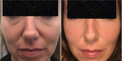 Woman treated with Dermal Fillers - Woman treated with Dermal Fillers using hyaluronic-acid fillers to fill and correct under-eyehollows