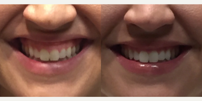 Woman treated with Botox for Gummy Smile - Woman treated with Botox for Gummy Smile