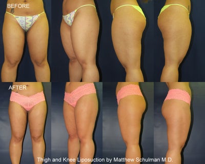 26 Year Old Student, Front & Inner Thigh Lipo - New York, NY 