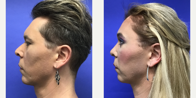 Patient treated with Facial Feminization Surgery, Transgender Facial Feminization Surgery, Septoplasty, Rhinoplasty, Voluma, Juv - 35 to 44 year-old female patient is 3 months post-op from Facial Feminization surgery. Her procedures included: Forehead Lift, Hairline Lowering, Supra Orbital Bone Reduction and Contouring, Septorhinoplasty (closed) with Cartilage Grafts and Radix Graft, Chin Reduction and Contour, Lower Eyelid Blepharoplasty (TC) with Fat Reposition, Thyroid Cartilage Shave and Voice Feminization, Fascia to Lips, 500 Micrografts to Recessions, 35% TCA Peel - Periorbital, 2cc Voluma to Medial Cheeks, and 2cc Juvederm - Perioral.