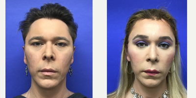 Patient treated with Facial Feminization Surgery, Transgender Facial Feminization Surgery, Septoplasty, Rhinoplasty, Voluma, Juv - 35 to 44 year-old female patient is 3 months post-op from Facial Feminization surgery. Her procedures included: Forehead Lift, Hairline Lowering, Supra Orbital Bone Reduction and Contouring, Septorhinoplasty (closed) with Cartilage Grafts and Radix Graft, Chin Reduction and Contour, Lower Eyelid Blepharoplasty (TC) with Fat Reposition, Thyroid Cartilage Shave and Voice Feminization, Fascia to Lips, 500 Micrografts to Recessions, 35% TCA Peel - Periorbital, 2cc Voluma to Medial Cheeks, and 2cc Juvederm - Perioral.