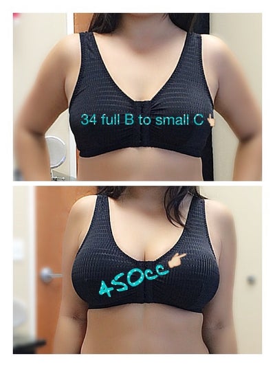 30years young, 34b to 430cc. - Fresno, CA - Review - RealSelf