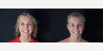 25-34 year old gender nonconforming person treated with Dermal Fillers, Cheek Fillers - In patients with severe skeletal structure disorders, jaw (orthognathic) surgery is used to improve the appearance of the jaw and correct the resulting functional and aesthetic disorders.