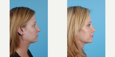 33 year old woman treated with Rhinoplasty - A 33 year old woman before and after Rhinoplasty with Andrew T. Lyos M.D FACS.