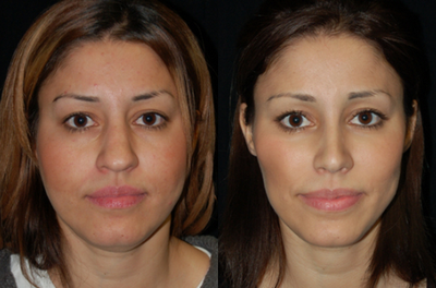 25-34 year old woman treated with Buccal Fat Removal - Buccal fat pad removal is a plastic surgery procedure for reducing prominent cheeks, by the proportional removal of buccal fat-pad tissue.