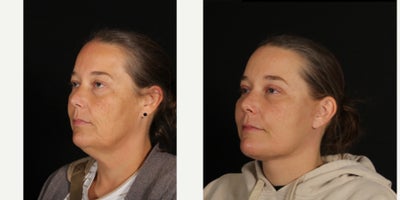 45-54 year old woman treated with Facelift, Neck Lift, Facial Fat Transfer, Double Eyelid Surgery, Eyelid Surgery - Our patient is 2 months out from a deep plane face and neck lift, upper and lower blepharoplasty, and facial fat grafting and she is healing beautifully! Thank you to her for allowing us to share! My favorite part is the new neck contour. To achieve this, we performed deep neck sculpting - partially removing submandibular glands and deep volume and tightening the muscles in the neck. Then we lifted and volumized the lateral neck and face. The blepharoplasty and fat grafting also help rejuvenate her eyes, temples and cheeks. As time passes swelling below her neck will continue to improve and the incisions will get even less perceptible.