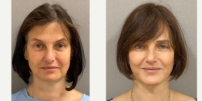 55-64 year old woman treated with Deep Plane Facelift, Facelift, SMAS Facelift, Neck Lift, Lower Facelift, Brow Lift - 55 yo s/p Facelift, brow lift and lower blepharoplasty performed under local anesthesia with sedation in our on site AAAA certified operating suite.