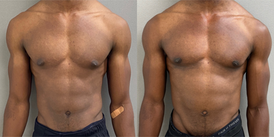 25 year old man treated with Gynecomastia Surgery - 25 yo s/p male breast reduction (gynecomastia) surgery performed under local anesthesia with sedation in our on site AAAA certified operating suite.