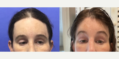 Patient treated with Brow Lift, Hair Transplant, Forehead Reduction - Revision Forehead Lift, Hairline Lowering, Orbital Bony Co - 35 to 44 year-old female patient is 1 year post-op from Facial Feminization surgery. Her procedures included: Revision Forehead Lift, Hairline Lowering, Orbital Bony Contouring, Septorhinoplasty Revision (closed) with Cartilage Grafts, Subnasal Lip Lift with Fascia to Lips Revision, Facelift/Necklift with Soft Tissue to Nasolabial Folds, 2cc Voluma to Medial Cheeks, 3 areas Botox to Glabella, Forehead, Lateral Canthal Lines, and 500 Micrografts to Recessions.