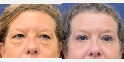 55-64 year old woman treated with Eyelid Surgery - Upper and lower blepharoplasty by Dr. Peter Butler.