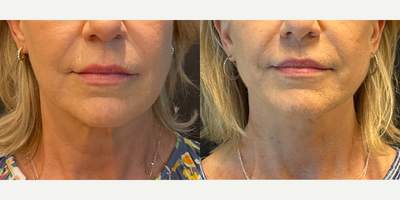 Woman treated with Neck Lift - Woman treated with Neck Lift