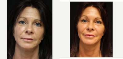 45-54 year old woman treated with ArteFill - Results, Patient Treated with Bellafill
