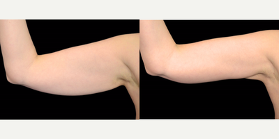 25-34 year old woman treated with Exilis - This patient had the 4 Exilis Ultra 360 treatments on her arms and had great results! The Exilis Ultra can be used on problem areas, anywhere from head to toe, that working out and exercise just won't get. It is the first and only device that burns fat and tightens skin simultaneously.