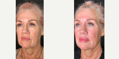 55-64 year old woman treated with Sculptra, Collagen Injection - Results after using 2 vials of Sculptra.