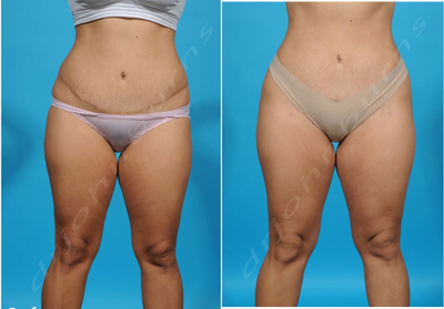 25-34 year old woman treated with Liposuction Revision - Revision liposuction as part of a Brazilian Butt Lift