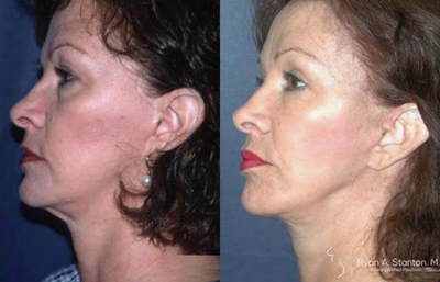 Woman treated with Facelift - Woman treated with Facelift