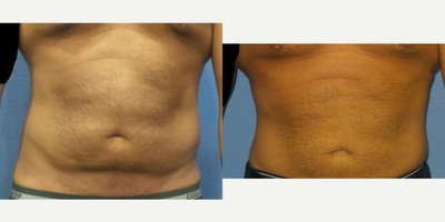 34 year old man treated with BodyTite - 34 y/o male who is shown 3 months after Bodytite liposuction to his abdomen.