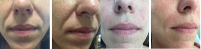 25-34 year old woman treated with Juvederm - natural filling of the laugh lines