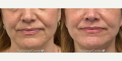 45-54 year old woman treated with Ellacor - Ellacor