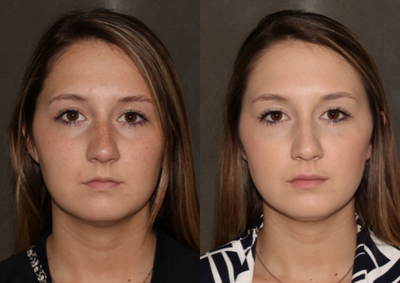 22 year old woman treated with Revanesse Versa  (Under eye and lips) - Tear trough and lips treated with a total of 1 syringe of Revanesse Versa. Patient also treated with Jeuveau (prabotulinumtoxinA-xvfs) in the glabella and forehead
