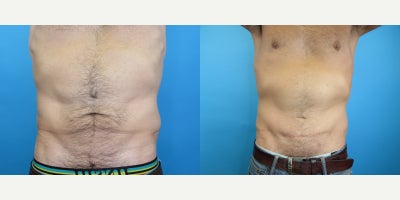 Man treated with Tummy Tuck - Man treated with Tummy Tuck