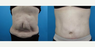 Woman treated with Tummy Tuck - Woman treated with Tummy Tuck