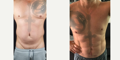 35-44 year old man treated with SAFELipo - High definition Lipo