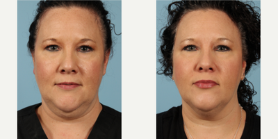 35-44 year old woman treated with CoolMini - 35-44 year old woman treated with CoolMini