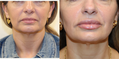 45-54 year old woman treated with RHA Collection Fillers - Juvederm Fillers. 1 Syringe Lips.