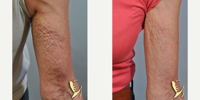 65-74 year old woman treated with Skin Tightening - Profound RF | Skin Tightening